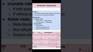 Ventricular Tachycardia [upl. by Yrelbmik782]