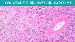 Low grade fibromyxoid sarcoma LGFMS Evans tumor explained in 5 minutes pathology [upl. by Latreshia]