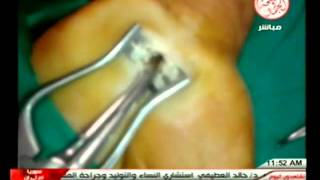 carpal tunnel release عملية تسليك عصبflv [upl. by Nnaarat]