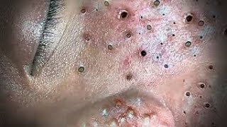 Toltal Best blackheads by Loan Nguyen No ads [upl. by Constancy616]