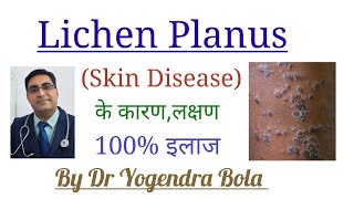 Lichen Planus  Skin Disease  के कारण लक्षण और 100 इलाज  By Dr Yogendra Bola [upl. by Oric]