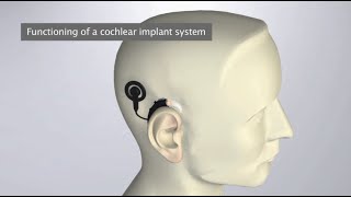 How does a Cochlear Implant work [upl. by Ettesel]