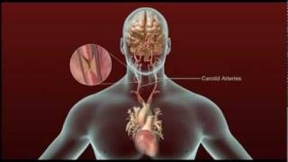 Stroke  Carotid Artery Disease and TIA [upl. by Moriah]