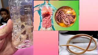 Ascaris lumbricoides roundworms roundworms aiims medicalsurgicalnursing mbbs medical [upl. by Ankeny995]