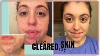 HOW I CLEARED MY SKIN  My Journey with Curology [upl. by Nigem]