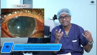 What is the role of corneal transplantation in treating corneal blindness [upl. by Saibot124]