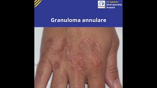 Granuloma annulare   Know Symptoms and Causes of Granuloma annulare  slmsh [upl. by Forland]