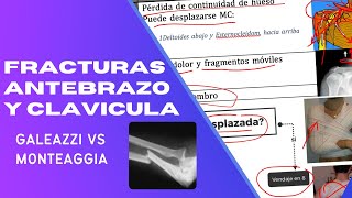 ORTOPEDIA FRACTURAS DE ANTEBRAZO Y CLAVICULA GALEAZZI VS MONTEGGIA [upl. by Zeugirdor]