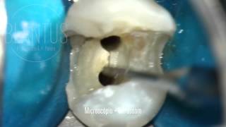 Microsonic in Endodontics [upl. by Esahc]