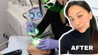 ⚡️REMOVING MY FRECKLES WITH PICOWAY LASER ⚡️WHAT YOU NEED TO KNOW 👀 [upl. by Ruthanne116]