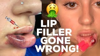 LIP FILLER GONE WRONG [upl. by Mohammed]