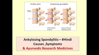 Ankylosing Spondylitis l Treatment l Ankylosing Spondylitis Ayurvedic Treatment Hindi [upl. by Itnavart]