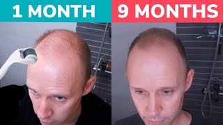 STOP BALDING  Regrow Hair Naturally with Dermaroller Real 9 Month Results [upl. by Ginnie]