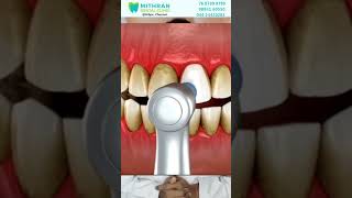 Stains on teeth  solution black stains on teeth Mithran dental dentist adyar [upl. by Ardnot]