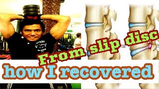 How i recovered from slip disc  Herinated disc  Bulging discs  L5S1 disc herniation [upl. by Letniuq]