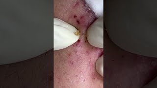 Big Cystic Acne Blackheads Extraction Blackheads amp Milia Whiteheads Removal Pimple Popping shorts [upl. by Runkel946]