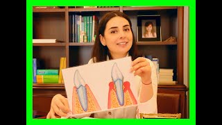 Periodontitis nedir  Küretaj tedavisi kimlere ve nasıl yapılır [upl. by Bruyn]