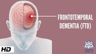 Frontotemporal Dementia Causes Signs and Symptoms Diagnosis and Treatment [upl. by Shawn]