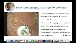 Placing Jejunal Feeding Tube Using the Extra Long Forceps Clip [upl. by Nohtahoj]