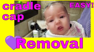 Revealing the Secret to Removing Cradle Cap in Seconds [upl. by Fronniah737]