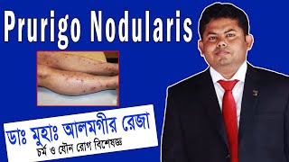 Prurigo Nodularis চিকিৎসা ও সঠিক ব্যবস্থাপনা  ডা আলমগীর রেজা  প্রুরিগো নোডুলারিস চিকিত্সা [upl. by Burnie936]