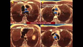 Matching anatomical relations in thoracic cross sections [upl. by Refinaj]