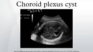 Choroid plexus cyst [upl. by Learrsi]