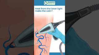 Varicose Veins Treatment Procedure  Glamyo Health [upl. by Balch]