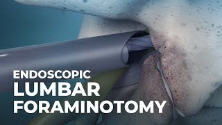 What is Endoscopic Lumbar Foraminotomy  Atlantic Spine Center [upl. by Darum]