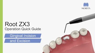 Root ZX3 Operation Quick Guide  Gingival Incisions and Excisions [upl. by May]