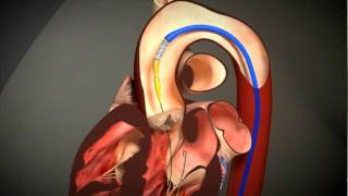 Transcatheter Aortic Valve Replacement TAVR animation [upl. by Dayir]