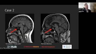 IIH MRI Findings in a Patient with Blurry Vision Headaches Tinnitus and Papilledema on Fundoscopy [upl. by Rehotsirhc312]