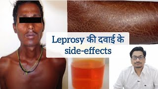 Leprosy की दवाई के sideeffects  Clofazimine  Hansepran  Rifampicin leprosy clofazimine कुष्ट [upl. by Ogdon515]