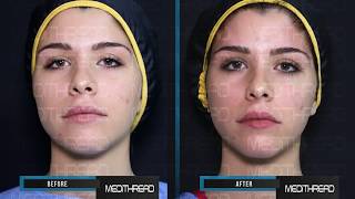 PDOTHREAD LIFT TUTORIAL BY MEDiTHREAD  BROW LIFT [upl. by Leslee]