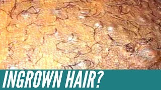 How to get rid of INGROWN HAIRS Expert tips that will get rid of them for good [upl. by Price]