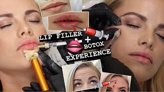 LIP FILLER  BOTOX EXPERIENCE  procedure recovery before and after [upl. by Darya]