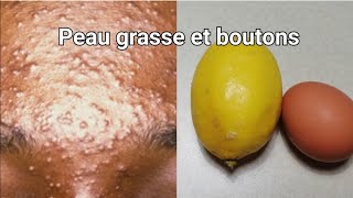 Comment se débarrasser dune peau grasse et de boutons sévères  Utilisez du citron  blanc dœuf [upl. by Durst]