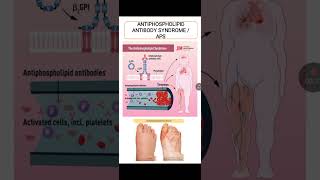 Antiphospholipid Antibody Syndrome [upl. by Zurn]