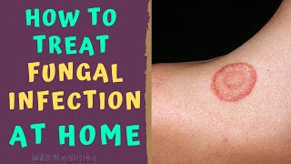 HOW TO TREAT SKIN FUNGAL INFECTION INFECTION AT HOME TINEA RINGWORM REMEDIES HOW TO CURE [upl. by Isewk]