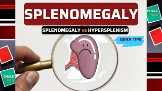 SPLENOMEGALY ENLARGEMENT OF THE SPLEEN [upl. by Eibo48]