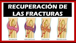 Consolidación de las Fracturas 🦴 Tiempo Fases [upl. by Anurb]