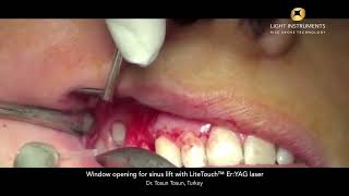 LiteTouch  Maxilofacial [upl. by Lehcear]