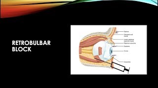 RETROBULBAR ANESTHESIA [upl. by Shep]