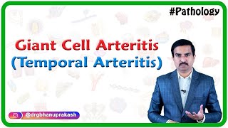 Giant cell arteritis Temporal arteritis Vasculitis Pathology  Usmle Step 1 [upl. by Fineberg]