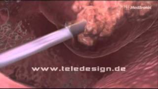 HNO 017 NasenPolypen Entfernung  PAL 169 HNO 017 Removal of nasal polyps  PAL 169 [upl. by Webster]