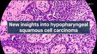 Probing the complexities of hypopharyngeal squamous cell carcinoma [upl. by Ejrog600]