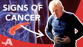 Early Signs of Pancreatic Cancer [upl. by Atteselrahc]