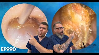 HUGE POLYPS PEELS amp MASSIVE EAR WAX PLUGS  EP990 [upl. by Burney]