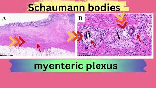 Schaumann bodies in Crohns disease [upl. by Bowman23]