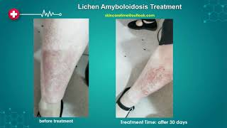 Lichen Amyloidosis Treatment Case Study 2019 2022 [upl. by Lichtenfeld686]